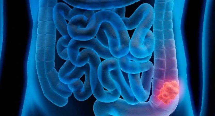 You are currently viewing Cancerul de colon, cunoscut si sub numele de cancer de intestin!