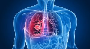 Read more about the article Cancerul Pulmonar