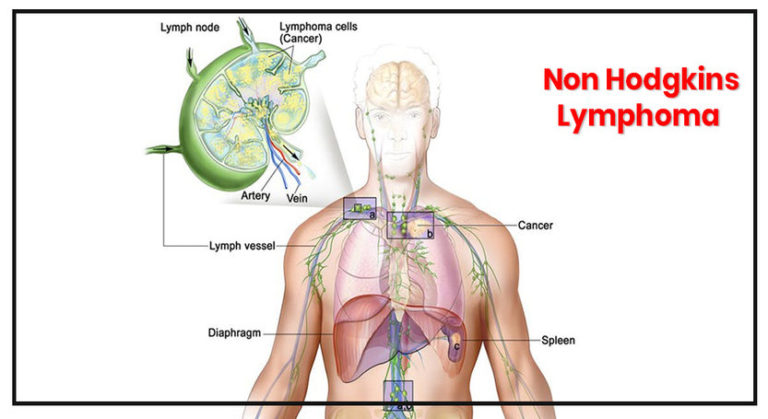 Cancerul limfatic: Limfomul non-Hodgkin si Hodgkin