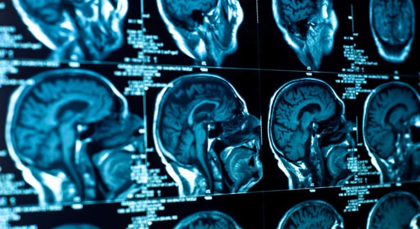 You are currently viewing Tumora Cerebrala – diferite tumori cerebrale, cauze si simptome